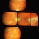 Resolution of retinal lesions associated with Retinitis